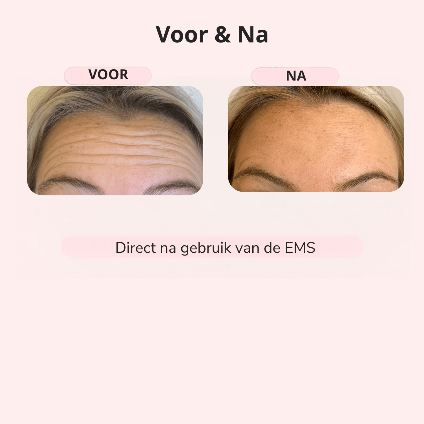 EMS LIFT – Strakkere Kaaklijn in 5 Min